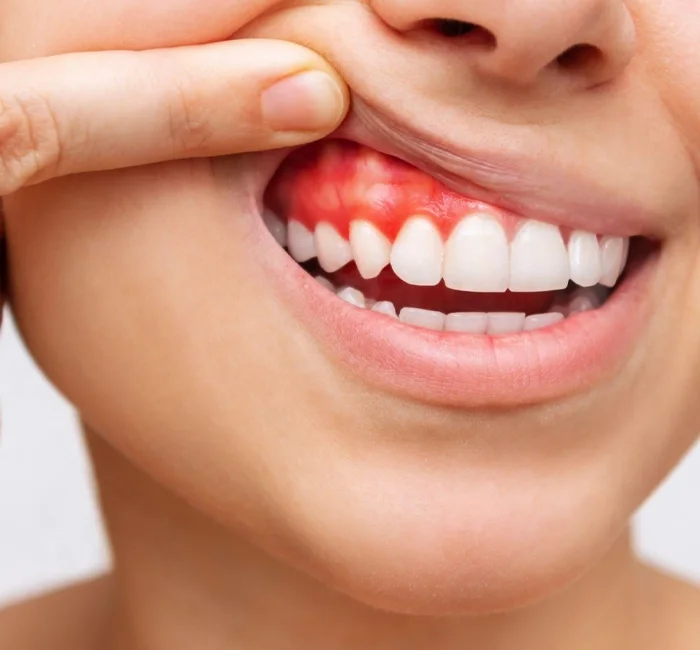 Close-up of a smile with red, inflamed gums showing early gum irritation