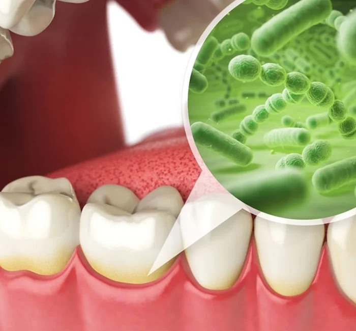 Dental illustration of teeth and gums with a magnified view of oral bacteria